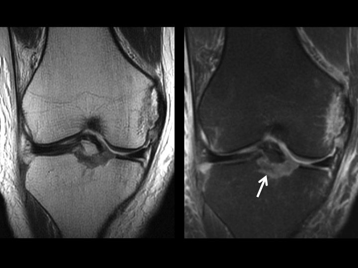 Figure 3 for case avulsion fracture ( RID4653 )
